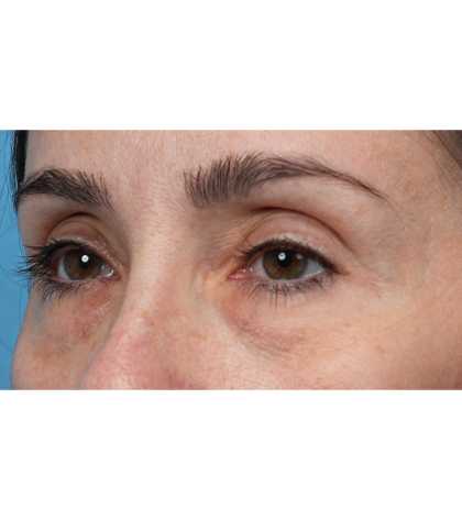 Lower Blepharoplasty Before & After Patient #3672