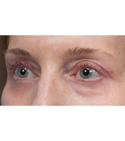 Upper Blepharoplasty Before & After Patient #3715
