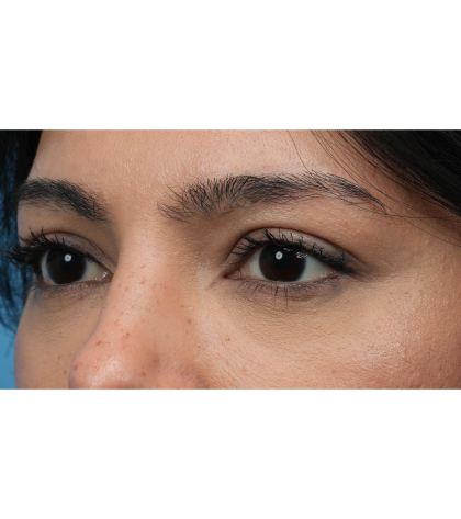 Lower Blepharoplasty Before & After Patient #3704
