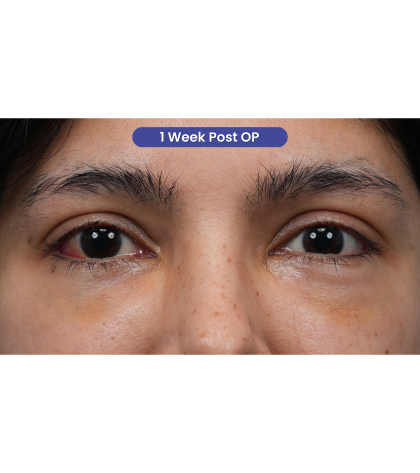 Lower Blepharoplasty Before & After Patient #3704