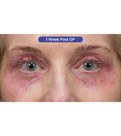 Upper Blepharoplasty Before & After Patient #3715