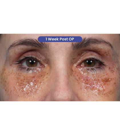 Lower Blepharoplasty Before & After Patient #3672