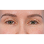 Upper Blepharoplasty Before & After Patient #3683