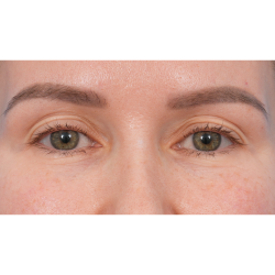 Upper Blepharoplasty Before & After Patient #3683