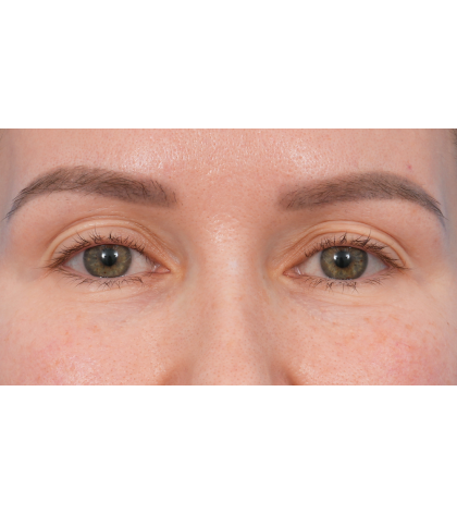 Upper Blepharoplasty Before & After Patient #3683