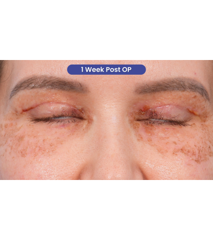 Upper Blepharoplasty Before & After Patient #3683