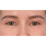 Upper Blepharoplasty Before & After Patient #3683