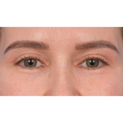 Upper Blepharoplasty Before & After Patient #3683
