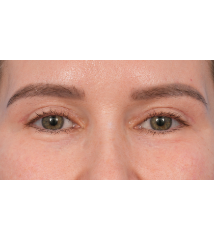 Upper Blepharoplasty Before & After Patient #3683