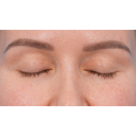 Upper Blepharoplasty Before & After Patient #3683