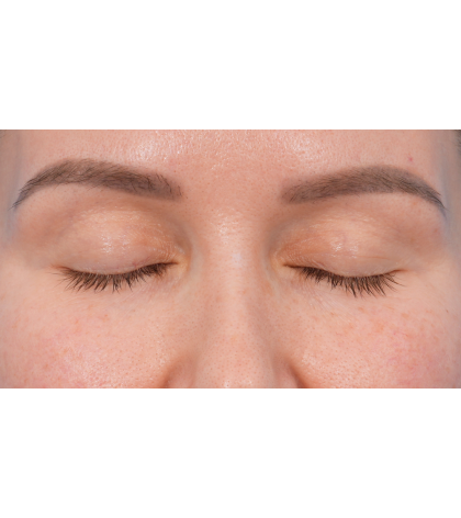 Upper Blepharoplasty Before & After Patient #3683
