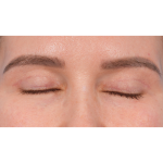Upper Blepharoplasty Before & After Patient #3683