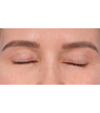 Upper Blepharoplasty Before & After Patient #3683