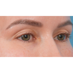Upper Blepharoplasty Before & After Patient #3683