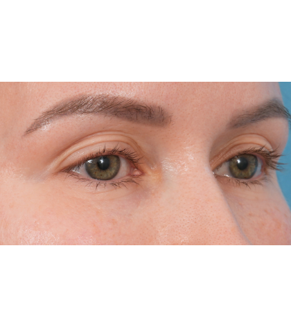Upper Blepharoplasty Before & After Patient #3683