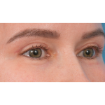 Upper Blepharoplasty Before & After Patient #3683
