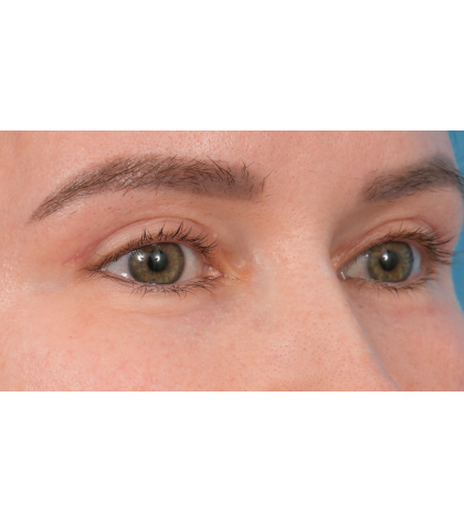 Upper Blepharoplasty Before & After Patient #3683