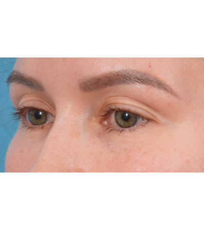 Upper Blepharoplasty Before & After Patient #3683