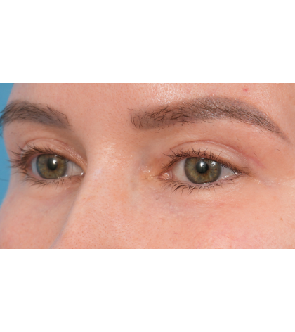 Upper Blepharoplasty Before & After Patient #3683