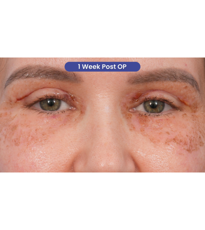 Upper Blepharoplasty Before & After Patient #3683