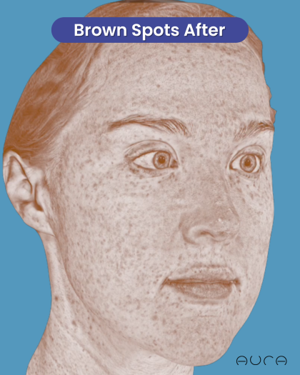 CO2 Laser Resurfacing Before & After Patient #3766