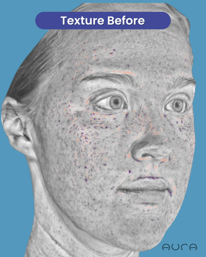 CO2 Laser Resurfacing Before & After Patient #3766