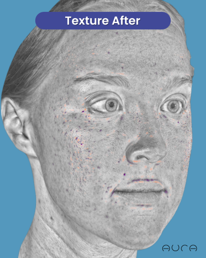 CO2 Laser Resurfacing Before & After Patient #3766
