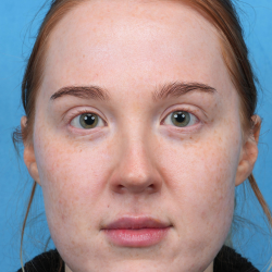 CO2 Laser Resurfacing Before & After Patient #3766