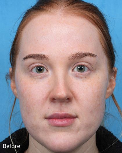 CO2 Laser Resurfacing Before & After Patient #3766