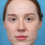 CO2 Laser Resurfacing Before & After Patient #3766