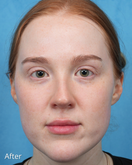 CO2 Laser Resurfacing Before & After Patient #3766