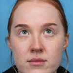 CO2 Laser Resurfacing Before & After Patient #3766
