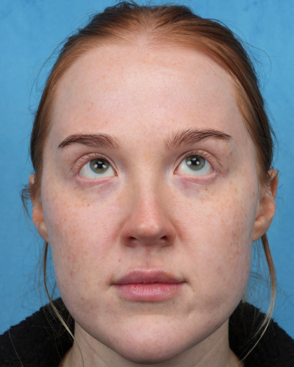 CO2 Laser Resurfacing Before & After Patient #3766