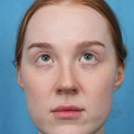 CO2 Laser Resurfacing Before & After Patient #3766