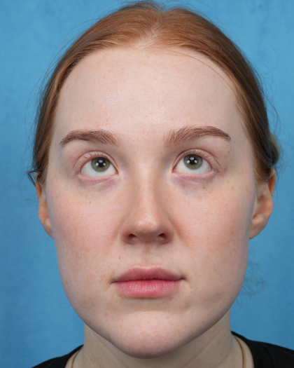 CO2 Laser Resurfacing Before & After Patient #3766