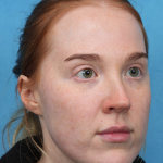 CO2 Laser Resurfacing Before & After Patient #3766