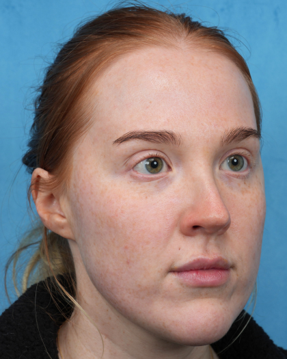 CO2 Laser Resurfacing Before & After Patient #3766