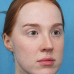 CO2 Laser Resurfacing Before & After Patient #3766