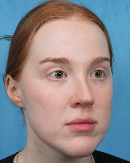 CO2 Laser Resurfacing Before & After Patient #3766