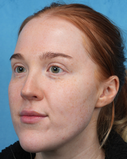 CO2 Laser Resurfacing Before & After Patient #3766