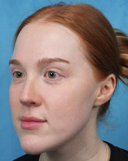 CO2 Laser Resurfacing Before & After Patient #3766