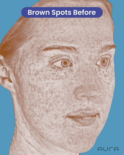CO2 Laser Resurfacing Before & After Patient #3766