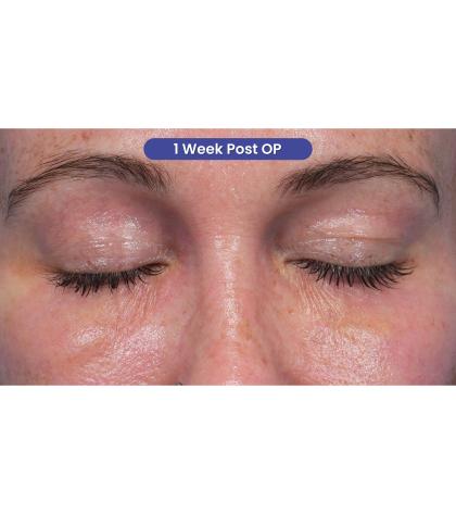 Lower Blepharoplasty Before & After Patient #3790