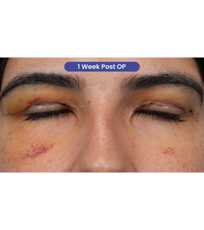 Upper Blepharoplasty Before & After Patient #3769