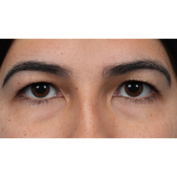 Upper Blepharoplasty Before & After Patient #3769