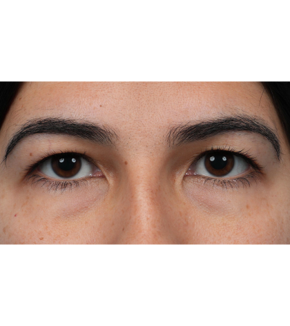 Upper Blepharoplasty Before & After Patient #3769