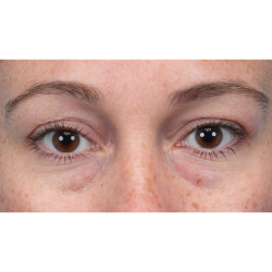 Lower Blepharoplasty Before & After Patient #3790