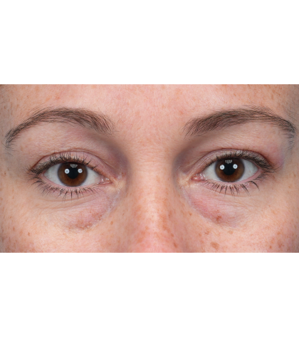 Lower Blepharoplasty Before & After Patient #3790