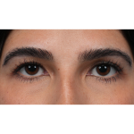 Upper Blepharoplasty Before & After Patient #3769