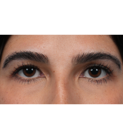 Upper Blepharoplasty Before & After Patient #3769